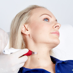 Halsstraffung Microneedling Linz. Straffere Haut durch Halslifting. Microneedling zur Halsstraffung. Micro Needling Hals, Microneedling Linz, Halslifting