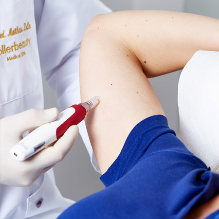 Hautstraffung Microneedling Linz. Straffere Haut durch Lifting mit dem Microneedling Pen. Haut Straffung, Haut Verjüngung. Microneedling zur Hautstraffung, Microneedling Linz