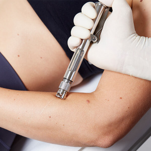 Narbenbehandlung von hypertrophen Narben Linz, Behandlung mit Laser und Dermo-Jet, verdickte und kordelförmige Narben. Narbenbehandlung Linz, Narbenbehandlung Hypertrope Narben, Lasertherapie, Dermojet Behandlung