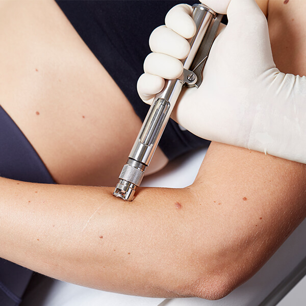 Narbenbehandlung von hypertrophen Narben Linz, Behandlung mit Laser und Dermo-Jet, verdickte und kordelförmige Narben. Narbenbehandlung Linz, Narbenbehandlung Hypertrope Narben, Lasertherapie, Dermojet Behandlung