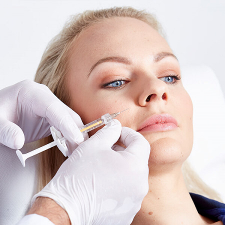 Nasolabialfalte unterspritzen Linz. Nasenlippenfurche entfernen, Faltenunterspritzung Gesicht, Nasolabialfalte entfernen, Gesichtsfalten Unterspritzung Linz, Faltenkorrektur im Gesicht.