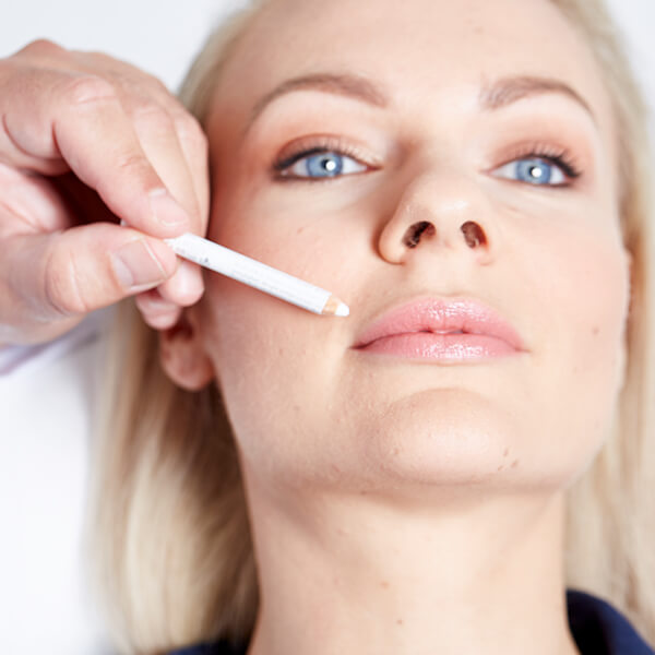 Nasolabialfalte unterspritzen in 4020 Linz. Nasolabialfalte entfernen, Faltenunterspritzung Gesicht, Faltenkorrektur im Gesicht, Nasenlippenfurche entfernen. Gesichtsfalten Unterspritzung Linz