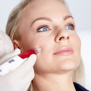 Gesichtsstraffung Microneedling in 4020 Linz. Microneedling Gesicht Lifting, Gesichtsverjüngung durch Microneedling. Microneedling zur Gesichtsstraffung im MED Zentrum 1 in Linz. Hautstraffung, strafferes Gesicht, Micro Needling Gesicht