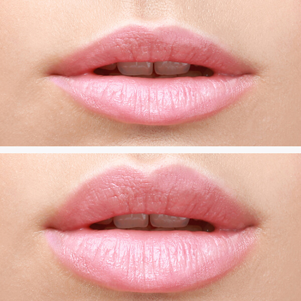 Lippen vergrößern Linz im MED Zentrum 1. Vorher Nachher Bild exemplarische Darstellung Dr. Koller