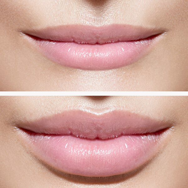 Lippen vergrößern Linz im MED Zentrum 1. Vorher Nachher Bild exemplarische Darstellung Dr. Koller