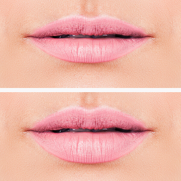 Lippen vergrößern Linz im MED Zentrum 1. Vorher Nachher Bild exemplarische Darstellung Dr. Koller